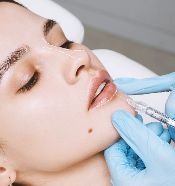 Hialuronidasa facial – Dra. Francine Bravo Procedimiento de hialuronidasa facial para disolver ácido hialurónico