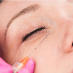 tratamiento de ojeras y bolsas con prostrolane en las condes