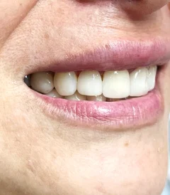 blanqueamiento dental