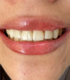 carillas dentales